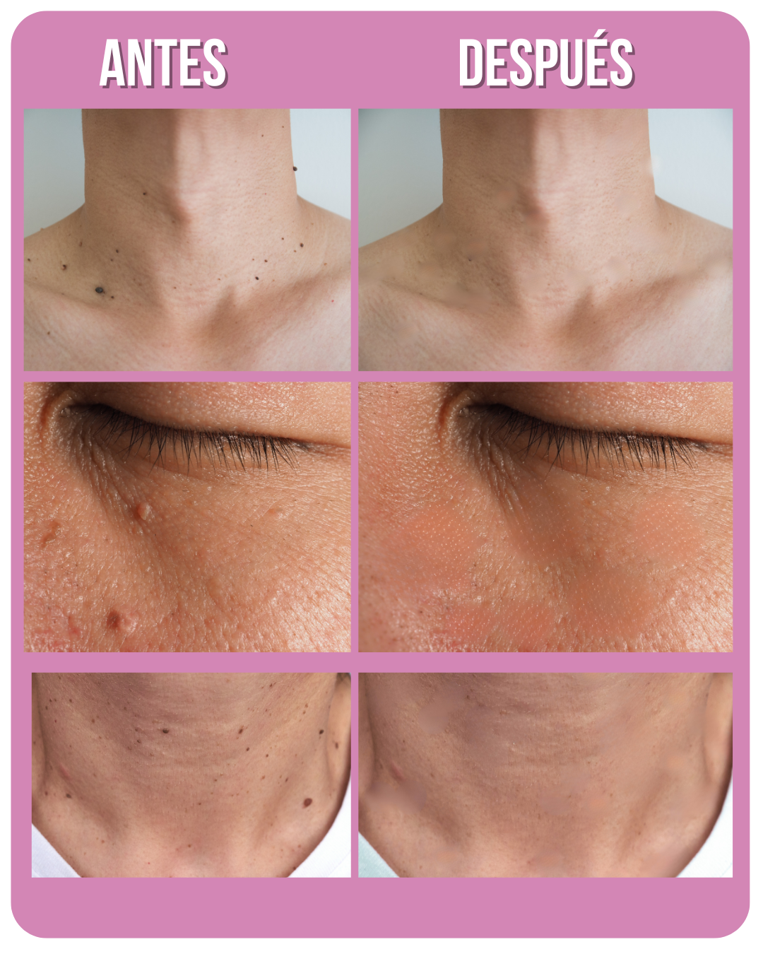 LUMINIIX - ADIÓS VERRUGAS - Adquira 1 Lleve 2