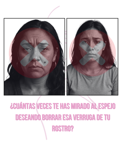 LUMINIIX - ADIÓS VERRUGAS - Adquira 1 Lleve 2
